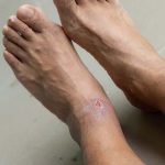 هرآنچه در مورد زخم پای وریدی باید بدانید!